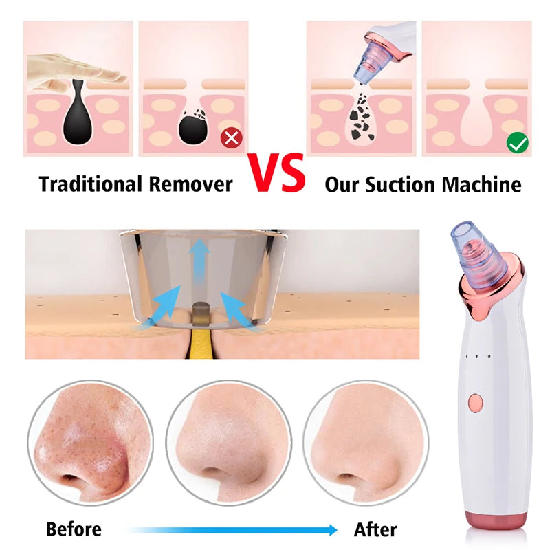 VELOURA Blackhead Remover Vacuum – USB